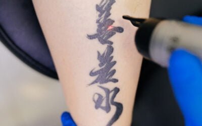 Laser Tattoo Removal