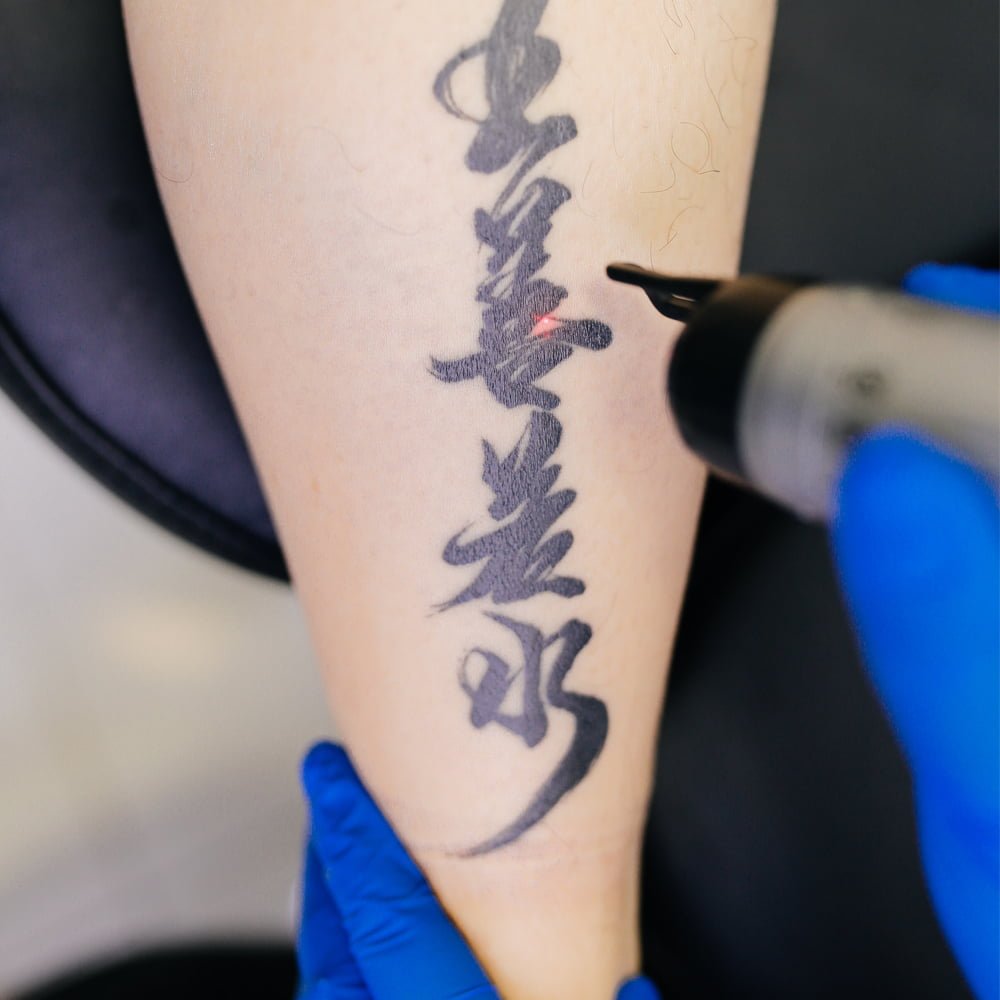 The 6 Best Tattoo Removal Services in Wellington [2024]